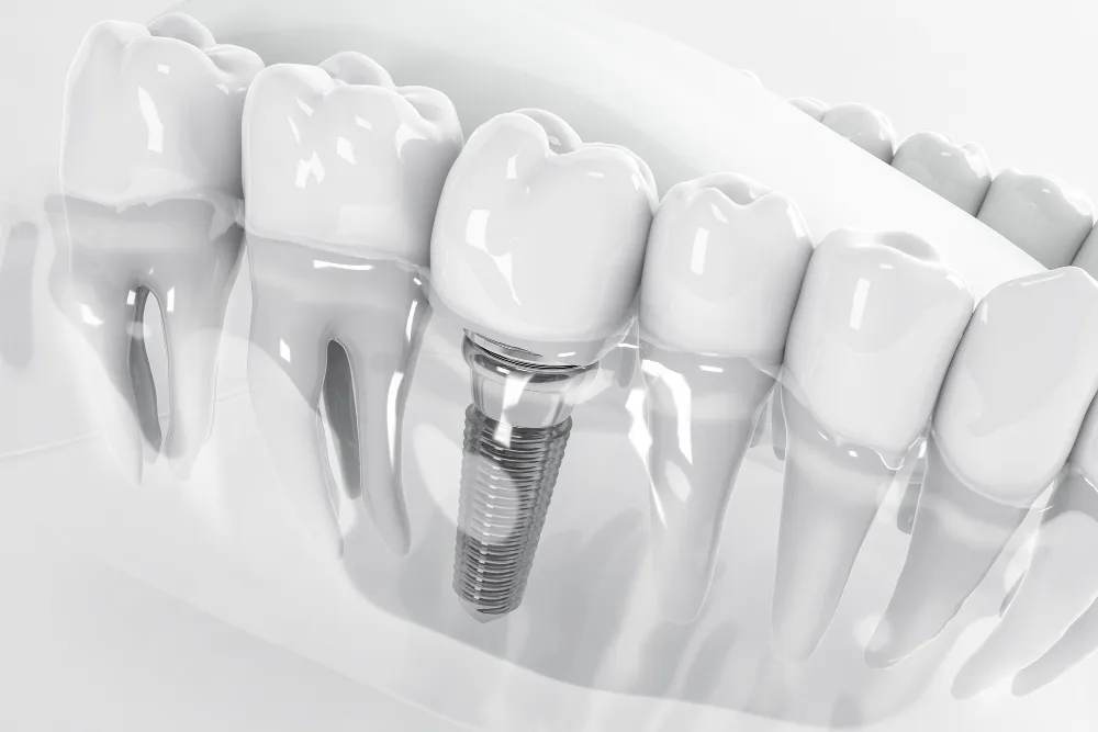 Implantate